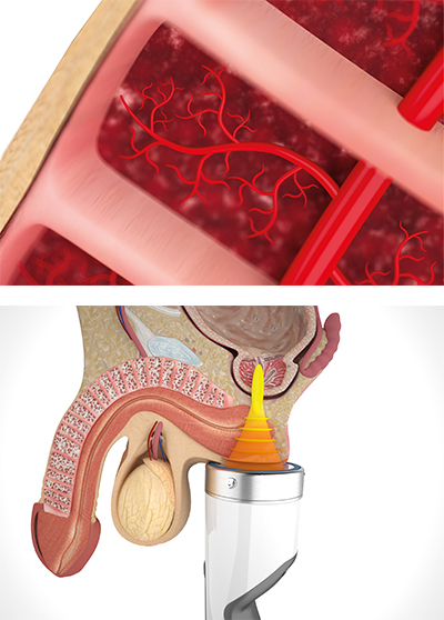 Causes of Erectile Dysfunction