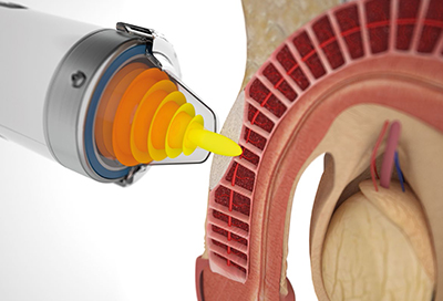 Erectile Dysfunction Specialist Care